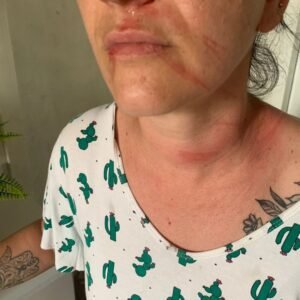 MORADORA DE OSÓRIO FICA FERIDA COM FIO À ALTURA DAS PESSOAS