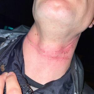 MOTOCICLISTA TEM PESCOÇO FERIDO EM CABO DE AÇO NO MUNICÍPIO DE OSÓRIO