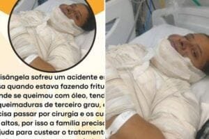 Mulher que teve corpo queimado ao fritar ovo morre após 10 dias internada