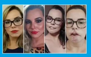 Influenciadora perde parte do lábio após procedimento com substância PMMA; entenda o caso