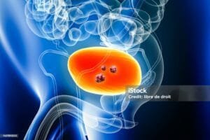 Câncer de bexiga: avançam as opções de tratamento Imunoterapia e terapia alvo estão entre as possibilidades a serem avaliadas