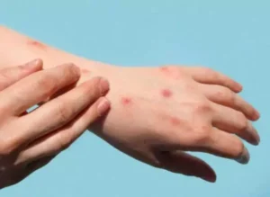 Prefeitura de Gravataí confirma primeiro caso de Mpox na cidade este ano