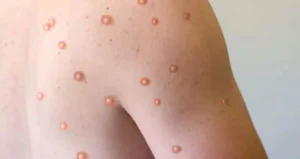 Vacina brasileira contra a mpox está próxima dos testes em humanos