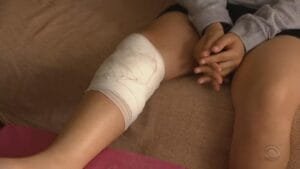 Criança de 10 anos leva mais de 40 pontos ao ser supostamente mordida por jacaré em Tramandaí