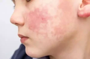 Médica explica os sintomas da celulite facial