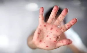 Após cinco anos, Brasil recupera certificado de País livre do sarampo