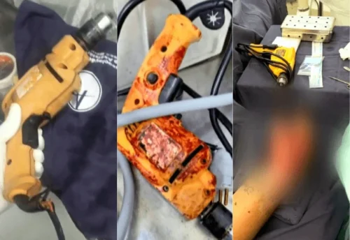 Hospital usa furadeira doméstica em cirurgias ortopédicas