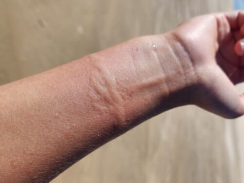 Cuidados com água-viva e outros animais marinhos exigem atenção redobrada à saúde da pele 2 FOTO PARA RELEASE 2