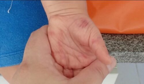 Prefeitura afasta Professoras após Denúncias de Maus-Tratos a Criança em Escola de Imbé