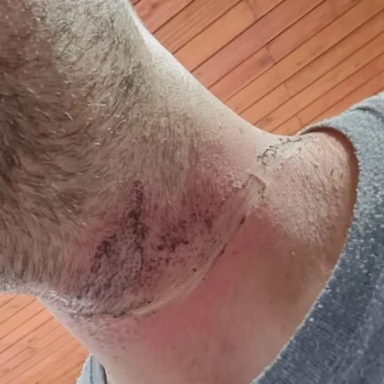 Motociclista fica ferido após fio de internet atingir pescoço na subida do Morro da Borússia. 3 778454613 1025918350310979 1036653416377933641 n