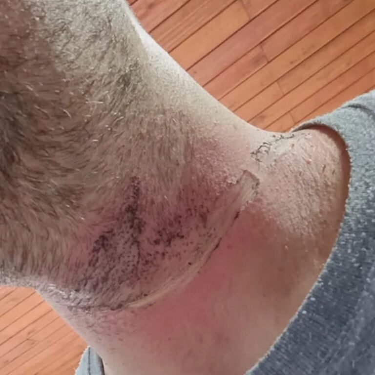Um motociclista ficou ferido após ser atingido por um fio de internet que estava na altura da via, na tarde desta quinta-feira (20), na subida do Morro da Borússia, em Osório.