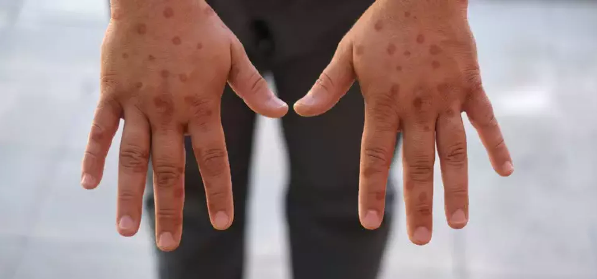 A doença é transmitida principalmente pelo contato direto com lesões na pele, secreções respiratórias e saliva. (Foto: Reprodução)