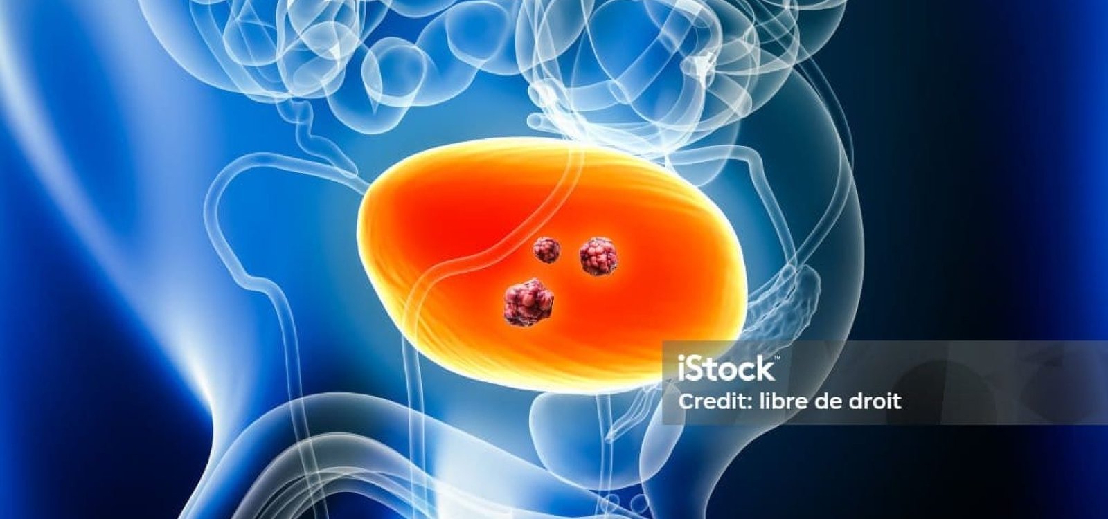 Urinary bladder cancer with organs and tumors or cancerous cells 3D rendering illustration with male body. Anatomy, oncology, biomedical, disease, medical, biology, science, healthcare concepts.